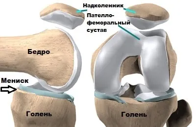 Вивих надколінка симптоми, лікування, операція (вивих надколінка звичний колінної чашечки лікування операція) Вивих надколінка симптоми, лікування, операція
