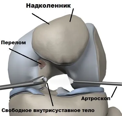 Вивих надколінка симптоми, лікування, операція (надколінка) Вивих надколінка симптоми, лікування, операція