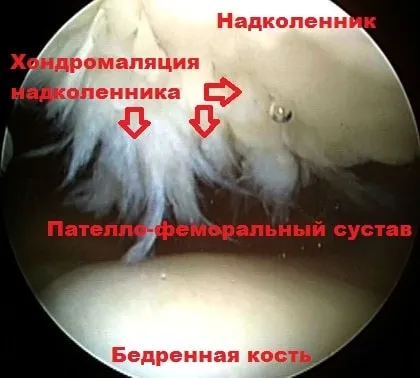 Вивих надколінка симптоми, лікування, операція (надколінка) Вивих надколінка симптоми, лікування, операція