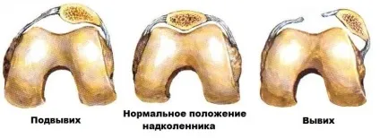 Вивих надколінка (звичний і постійно існуючий) симптоми, лікування, наслідки (вивих надколінка лікування) Вивих надколінка (звичний і постійно існуючий) симптоми, лікування, наслідки