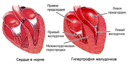 Висока верхній тиск при нормальному нижньому причини і лікування (тиск) Висока верхній тиск при нормальному нижньому причини і лікування