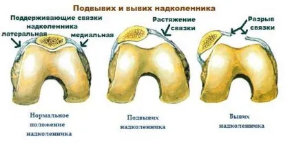 Вивих надколінка лікування і операція (операція) Вивих надколінка лікування і операція