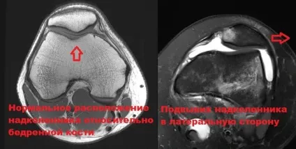 Вивих надколінка симптоми, лікування, операція (надколінка) Вивих надколінка симптоми, лікування, операція