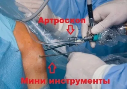 Вивих надколінка симптоми, лікування, операція (лікування) Вивих надколінка симптоми, лікування, операція