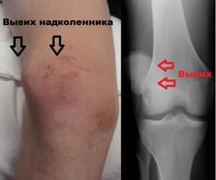 Вивих надколінка симптоми, лікування, операція (вивих) Вивих надколінка симптоми, лікування, операція