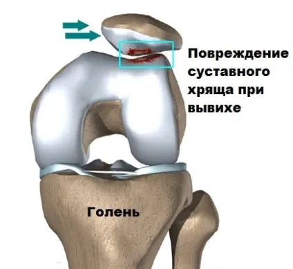 Вивих надколінка симптоми, лікування, операція (вивих надколінка звичний колінної чашечки лікування операція) Вивих надколінка симптоми, лікування, операція