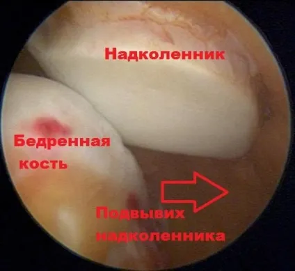 Вивих надколінка симптоми, лікування, операція (надколінка) Вивих надколінка симптоми, лікування, операція