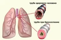 Бронхоспазм при алергії