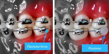 Брекети заважають або натирають (слизової оболонки ротової порожнини) Брекети заважають або натирають