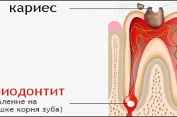 Запалення кореня зуба лікування в домашніх умовах (зуба) Запалення кореня зуба лікування в домашніх умовах