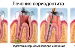 Запалення кореня зуба лікування в домашніх умовах (запалення) Запалення кореня зуба лікування в домашніх умовах