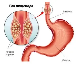 Запалення стравоходу лікування народними засобами (стравоходу) Запалення стравоходу лікування народними засобами