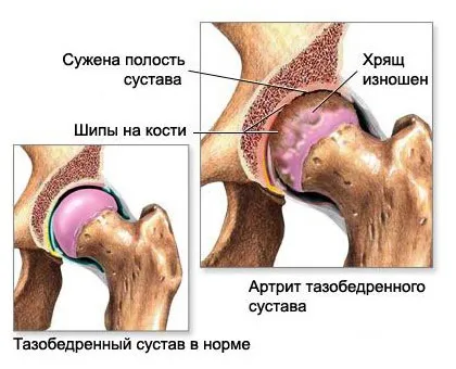 Запалення тазостегнового суглоба симптоми і лікування (симптоми) Запалення тазостегнового суглоба симптоми і лікування