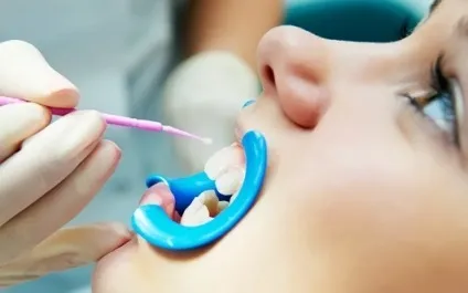 Відновлення емалі зубів (зміцнення емалі зубів) Відновлення емалі зубів