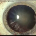 вторинна катаракта