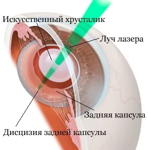 вторинна катаракта