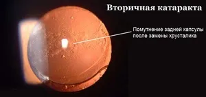 Вторинна катаракта після заміни кришталика симптоми, лазерне лікування і протипоказання, ціни (катаракта) Вторинна катаракта після заміни кришталика симптоми, лазерне лікування і протипоказання, ціни