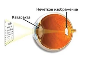 Вторинна катаракта після заміни кришталика симптоми, лазерне лікування і протипоказання, ціни (вторинна) Вторинна катаракта після заміни кришталика симптоми, лазерне лікування і протипоказання, ціни