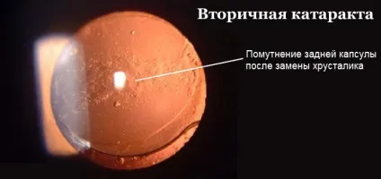 вторинна катаракта