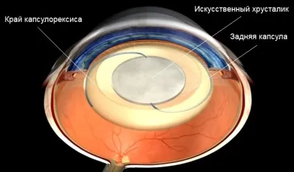 вторинна катаракта