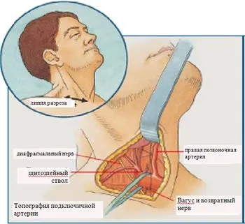 Хірургічне лікування атеросклеротичного ураження підключичної артерії - кардіолог - сайт про (підключичної) Хірургічне лікування атеросклеротичного ураження підключичної артерії - кардіолог - сайт про
