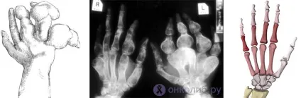Хондрома, Енхондрома, остеохондрома лікування, причини (хондрома) Хондрома, Енхондрома, остеохондрома лікування, причини