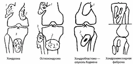 Хондрома, Енхондрома, остеохондрома лікування, причини (довгих трубчастих кісток) Хондрома, Енхондрома, остеохондрома лікування, причини