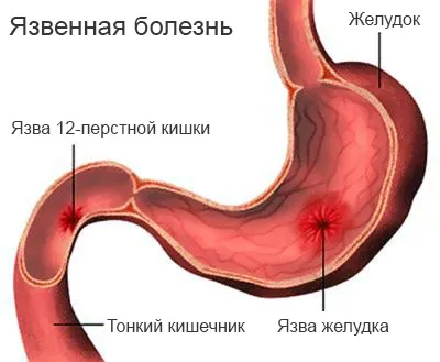 Захворювання органів травлення та їх профілактика (захворювання) Захворювання органів травлення та їх профілактика