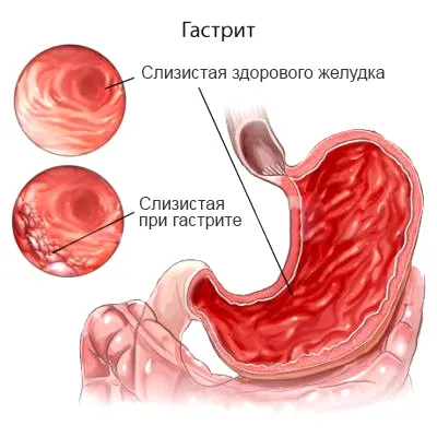 Захворювання органів травлення та їх профілактика (захворювання) Захворювання органів травлення та їх профілактика