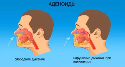 Закладена одна ніздря - чому не дихає то одна, то інша по черзі (ніздря) Закладена одна ніздря - чому не дихає то одна, то інша по черзі