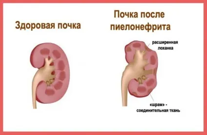 Захворювання нирок і назви список хвороб у людей (захворювання) Захворювання нирок і назви список хвороб у людей