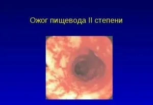 Печіння в стравоході, горлі при прийомі їжі причини (стравоході) Печіння в стравоході, горлі при прийомі їжі причини
