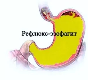 Печіння в стравоході, горлі при прийомі їжі причини (печіння) Печіння в стравоході, горлі при прийомі їжі причини