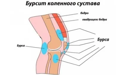 Бурсит колінного суглоба лікування народними засобами в домашніх умовах (суглоба) Бурсит колінного суглоба лікування народними засобами в домашніх умовах
