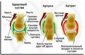 Чим відрізняється артрит від артрозу колінного суглоба подібності та відмінності (колінного) Чим відрізняється артрит від артрозу колінного суглоба подібності та відмінності