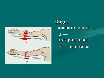 Чим відрізняється артеріальна кровотеча від венозного (артеріальна кровотеча венозного) Чим відрізняється артеріальна кровотеча від венозного