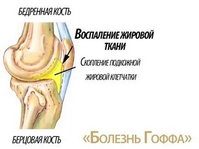 Чим небезпечна хвороба Гоффа (пошкодження жирового тіла колінного суглоба) (суглоба) Чим небезпечна хвороба Гоффа (пошкодження жирового тіла колінного суглоба)