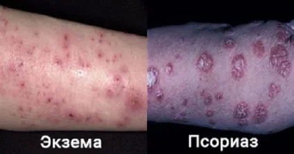 Чим відрізняється псоріаз від екземи ключові відмінності схожих патологій (псоріаз) Чим відрізняється псоріаз від екземи ключові відмінності схожих патологій