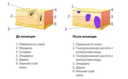 Чим відрізняється биоревитализация від мезотерапії особи і що краще вибрати (краще) Чим відрізняється биоревитализация від мезотерапії особи і що краще вибрати