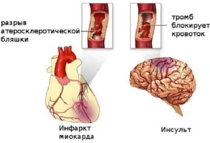 Чим відрізняється інфаркт від інсульту - відміну ознак, симптомів, лікування (інфаркт) Чим відрізняється інфаркт від інсульту - відміну ознак, симптомів, лікування