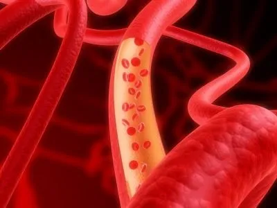 Чистка лімфи людини народними засобами в домашніх умовах (лімфи) Чистка лімфи людини народними засобами в домашніх умовах