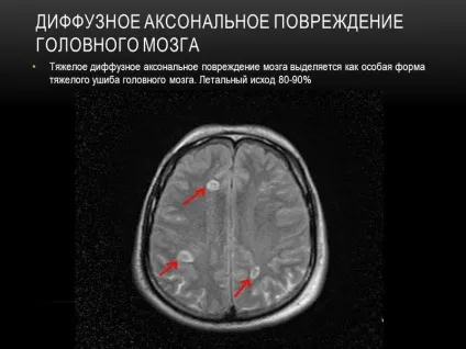 Що показує і визначає мрт головного мозку без контрасту (показує) Що показує і визначає мрт головного мозку без контрасту