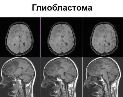 Що показує і визначає мрт головного мозку без контрасту (головного) Що показує і визначає мрт головного мозку без контрасту