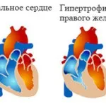 Асбестоз легких - симптоми, лікування (причини симптоми лікування) Асбестоз легких - симптоми, лікування