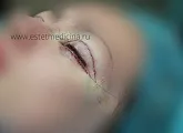 Блефаропластика нижніх і верхніх повік ціни, відгуки, клініка, інтернет-журнал (блефаропластика ціни) Блефаропластика нижніх і верхніх повік ціни, відгуки, клініка, інтернет-журнал