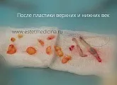 Блефаропластика нижніх і верхніх повік ціни, відгуки, клініка, інтернет-журнал (клініка) Блефаропластика нижніх і верхніх повік ціни, відгуки, клініка, інтернет-журнал