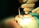 Блефаропластика нижніх і верхніх повік ціни, відгуки, клініка, інтернет-журнал (відгуки) Блефаропластика нижніх і верхніх повік ціни, відгуки, клініка, інтернет-журнал