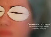 Блефаропластика нижніх і верхніх повік ціни, відгуки, клініка, інтернет-журнал (верхніх) Блефаропластика нижніх і верхніх повік ціни, відгуки, клініка, інтернет-журнал