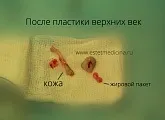 Блефаропластика нижніх і верхніх повік ціни, відгуки, клініка, інтернет-журнал (пластика повік) Блефаропластика нижніх і верхніх повік ціни, відгуки, клініка, інтернет-журнал