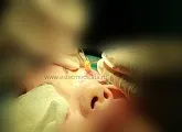 Блефаропластика нижніх і верхніх повік ціни, відгуки, клініка, інтернет-журнал (блефаропластика ціни) Блефаропластика нижніх і верхніх повік ціни, відгуки, клініка, інтернет-журнал